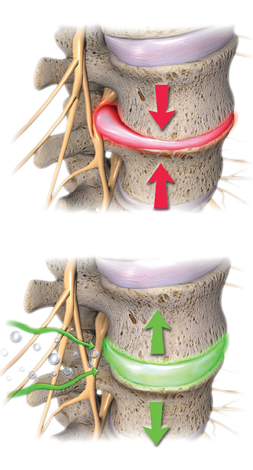 Spinal-decompression-therapy