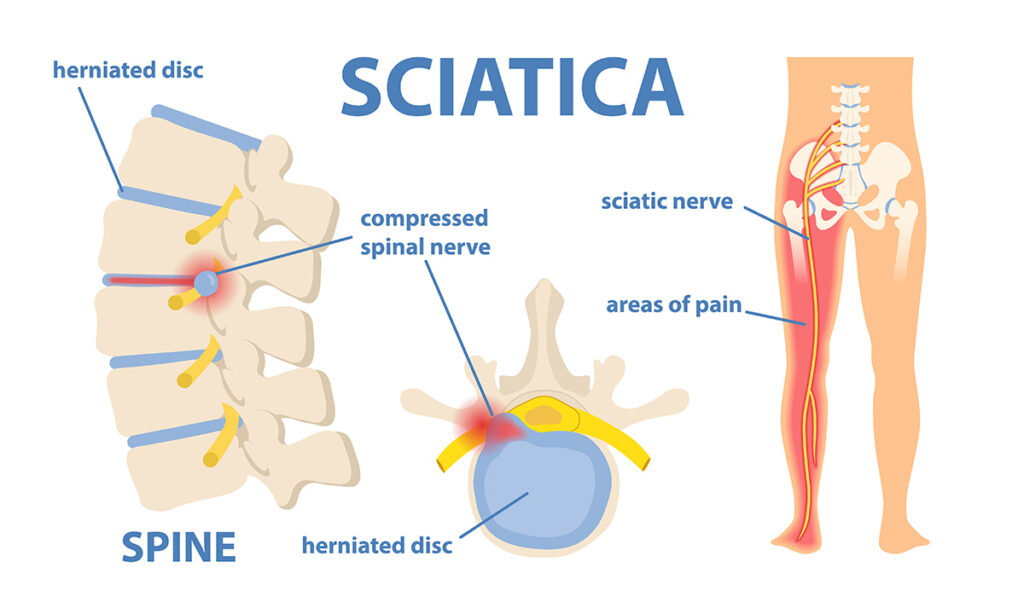 Vultures and sciatica that Dr Zac Hakes has treated as an osteopath in Ballina