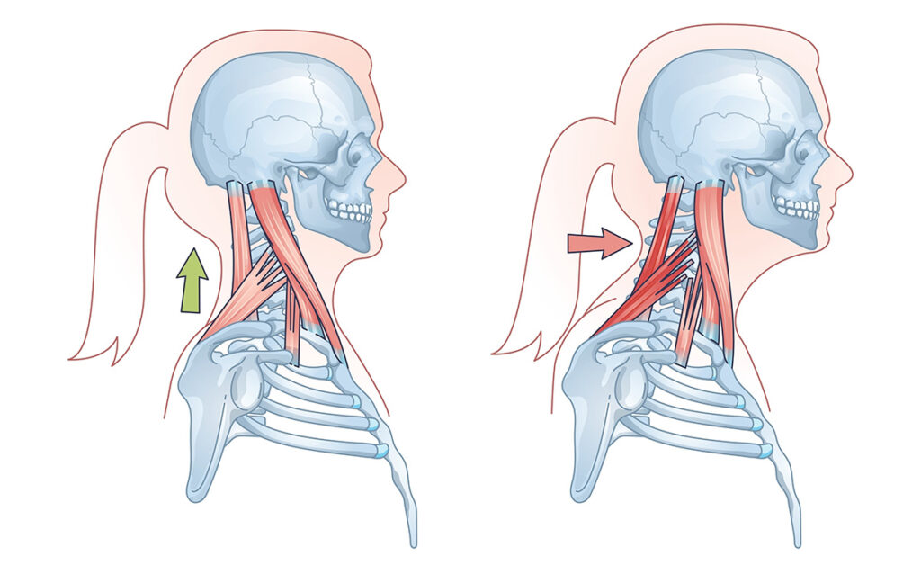 How I forward head carriage looks – Dr Zac Hakes osteopath treats this