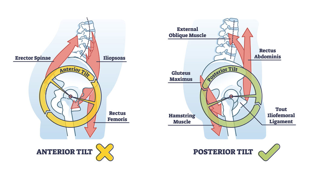 Dr. Zac Hakes at Riverside Wellness Centre focuses on improving the pelvic positioning or tilt as can be seen in this diagram.