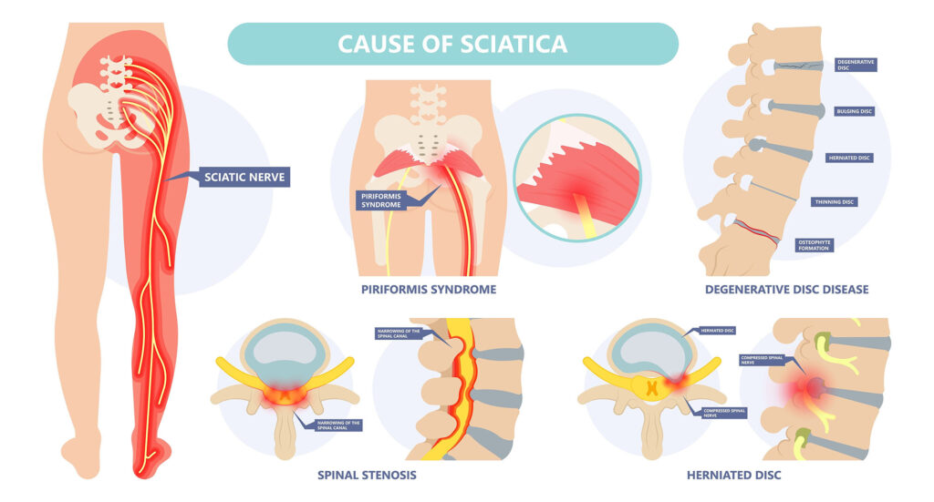 Causes of sciatica that Dr. Zac Hakes in Ballina can treat.