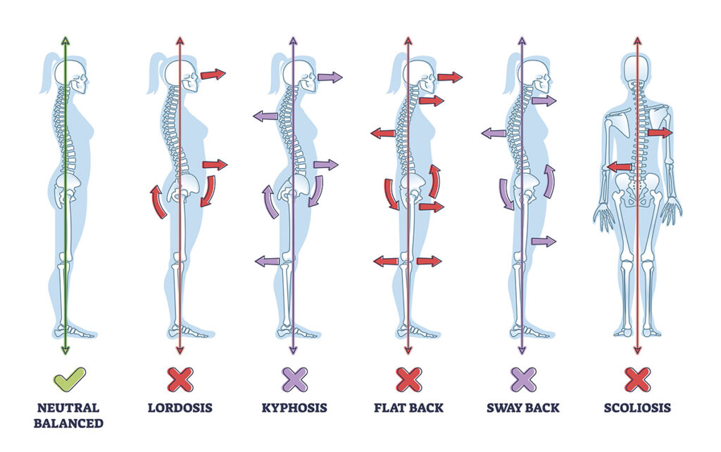 The types of bad posture Dr Zac Hakes at Riverside Wellness Centre treats