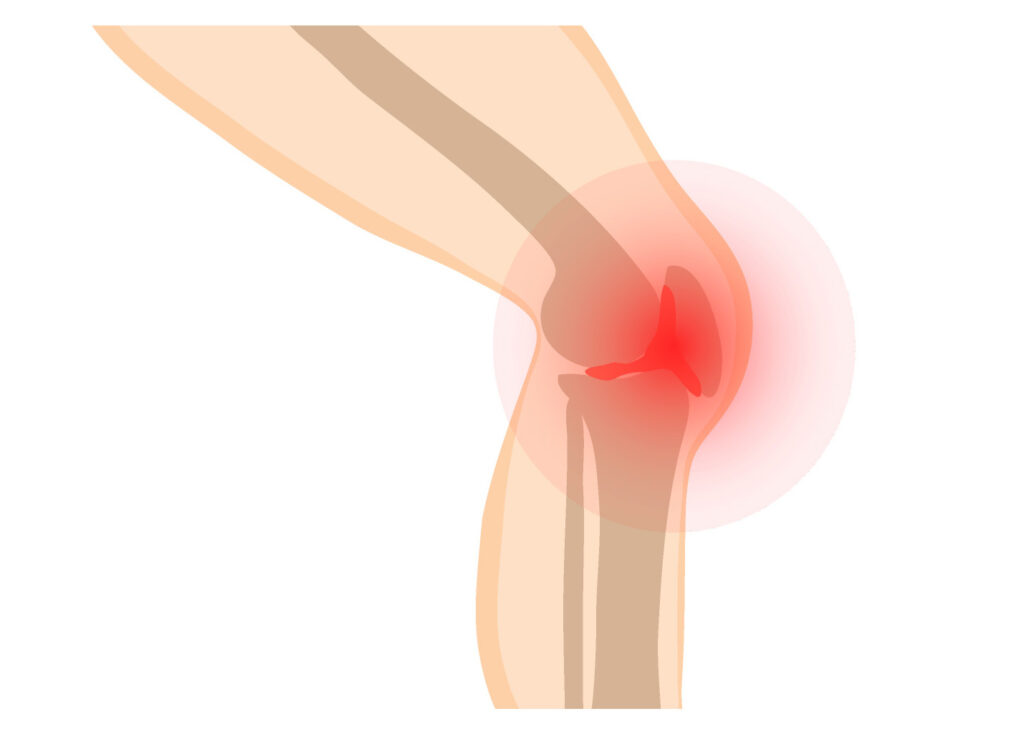 Knee joint pain diagram