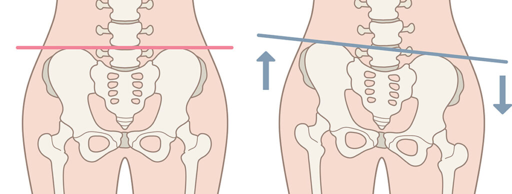 Diagram of hip and pelvis alignment