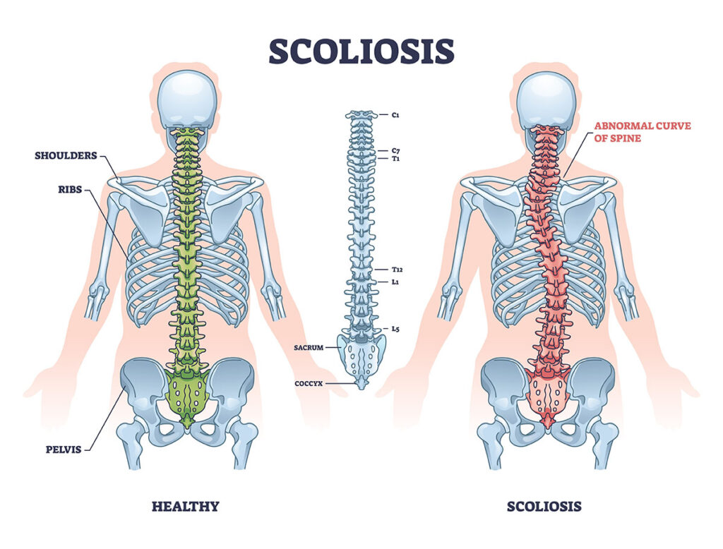 Diagram of scoliosis with abnormal curve spine and a healthy spine