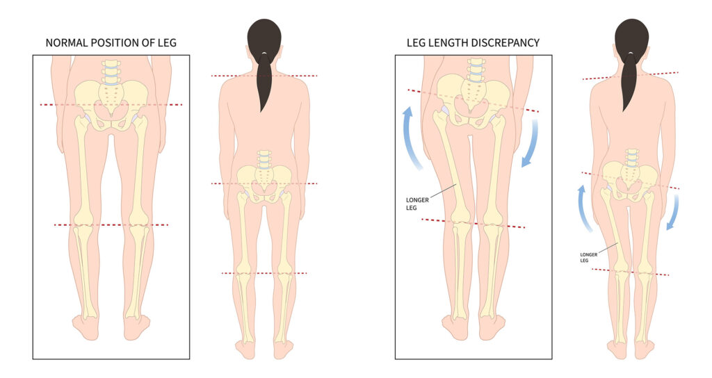 Scoliosis leg length discrepancy diagram with a normal position of leg also